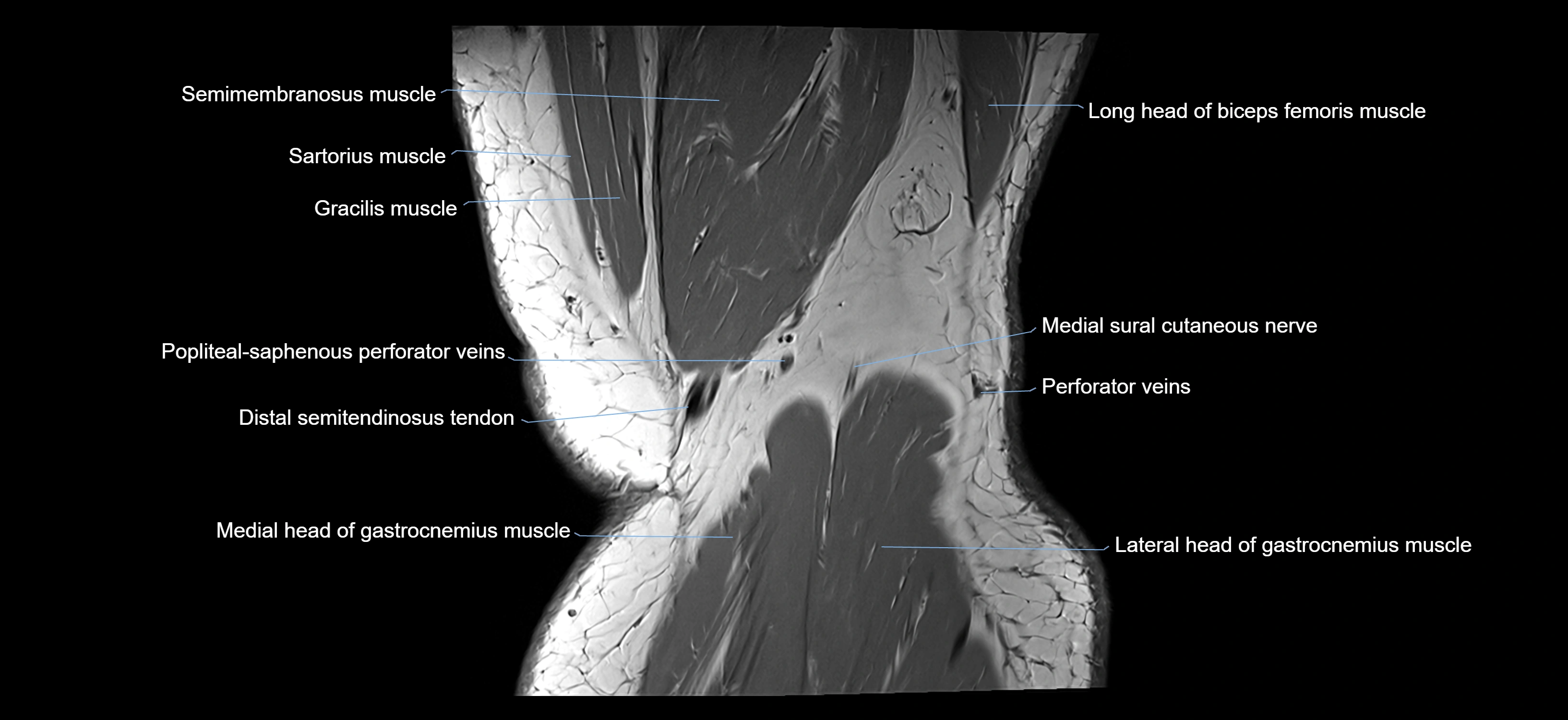 MRI knee coronal cross sectional anatomy labelled 3T radiology  image-04001-00041.webp